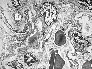 F,40y. | membranous glomerulopathy - lupus erythematodes